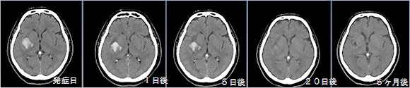 右被殻出血