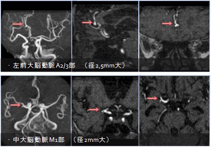 頭部単純ＭＲＡ検査  非造影ＭＲＡ