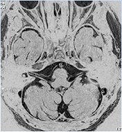 聴神経等ＭＲＩ検査